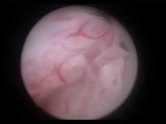 Гольмиевая энуклеация аденомы простаты